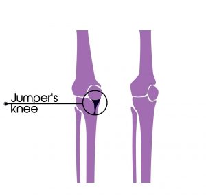 Jumpers knee