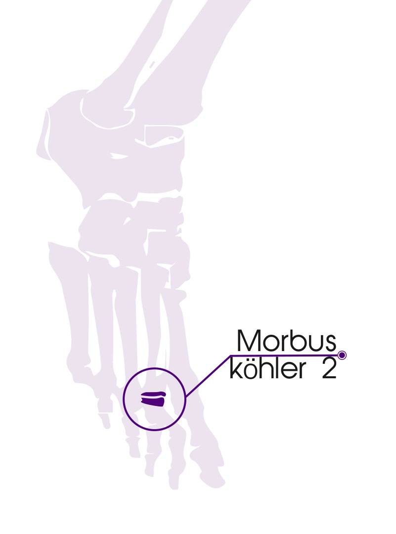 Morbus Kohler 2